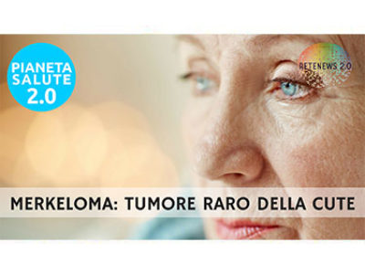 Merkeloma, tumore raro della cute. PIANETA SALUTE 2.0 - 115a puntata