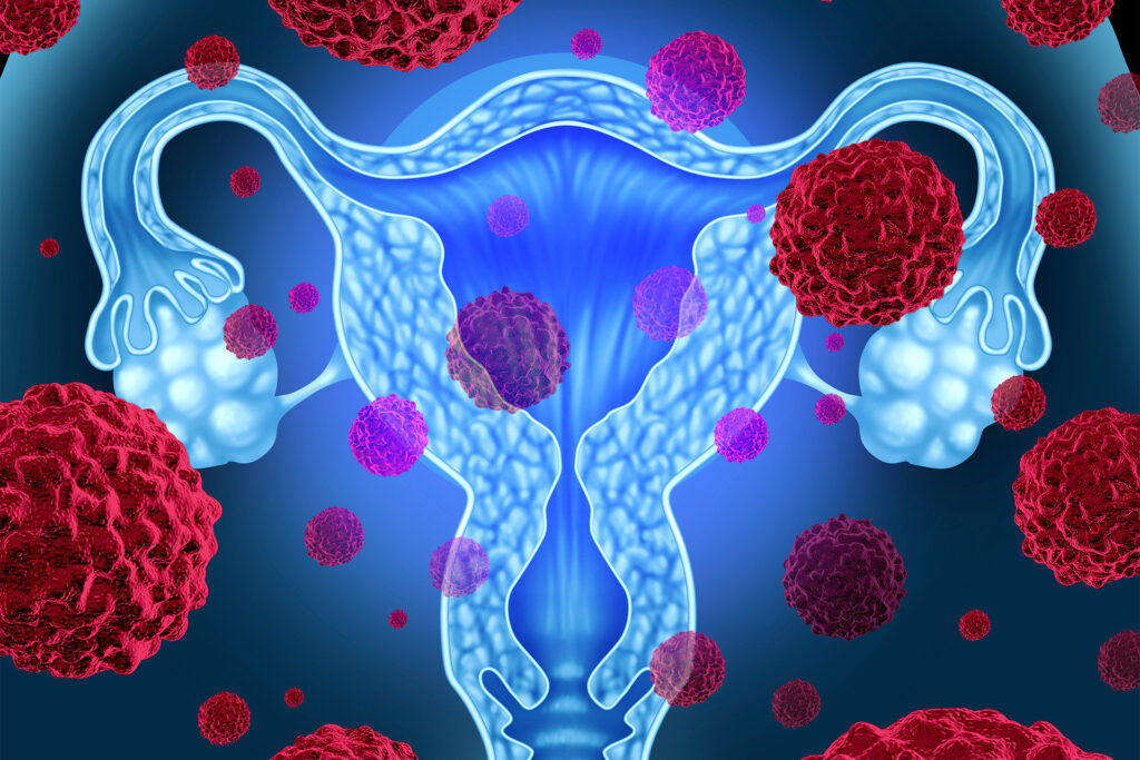 REGINA ELENA: INDIVIDUATE LE RELAZIONI PERICOLOSE TRA ALCUNE PROTEINE CHIAVE NEI TUMORI DELL’OVAIO