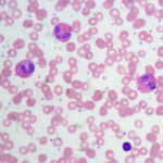 eosinofili globuli bianchi - Ed Uthman, MD, Houston, Texas, USA