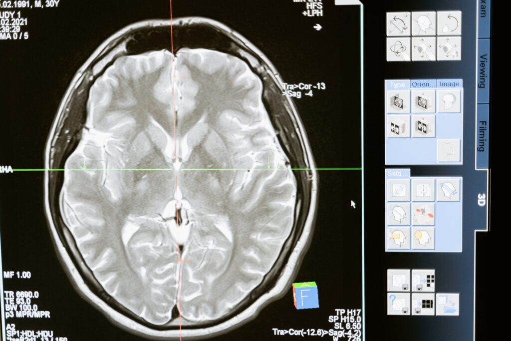 Le placche aterosclerotiche “dialogano” con il cervello