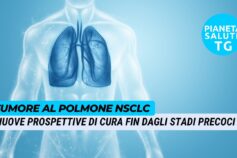 Approvato atezolizumab per tumore al polmone NSCLC riduce il rischio di recidiva o di morte del 57%