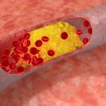 Ipercolesterolemia: Il CHMP esprime parere positivo per l’uso di acido bempedoico e dell’associazione fissa di acido bempedoico /ezetimibe nel trattamento dell’ipercolesterolemia per ridurre gli eventi cardiovascolari
