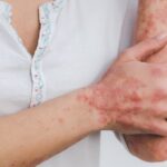 Una speranza in più per la psoriasi