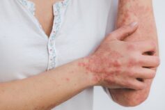 Una speranza in più per la psoriasi: verso il Piano Nazionale della cronicità