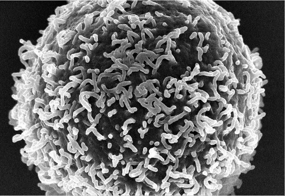 Sclerosi Multipla: uno studio immunologico svela come le vescicole extracellulari - piccolissime entità biologiche - mostrano un grande potenziale nella malattia