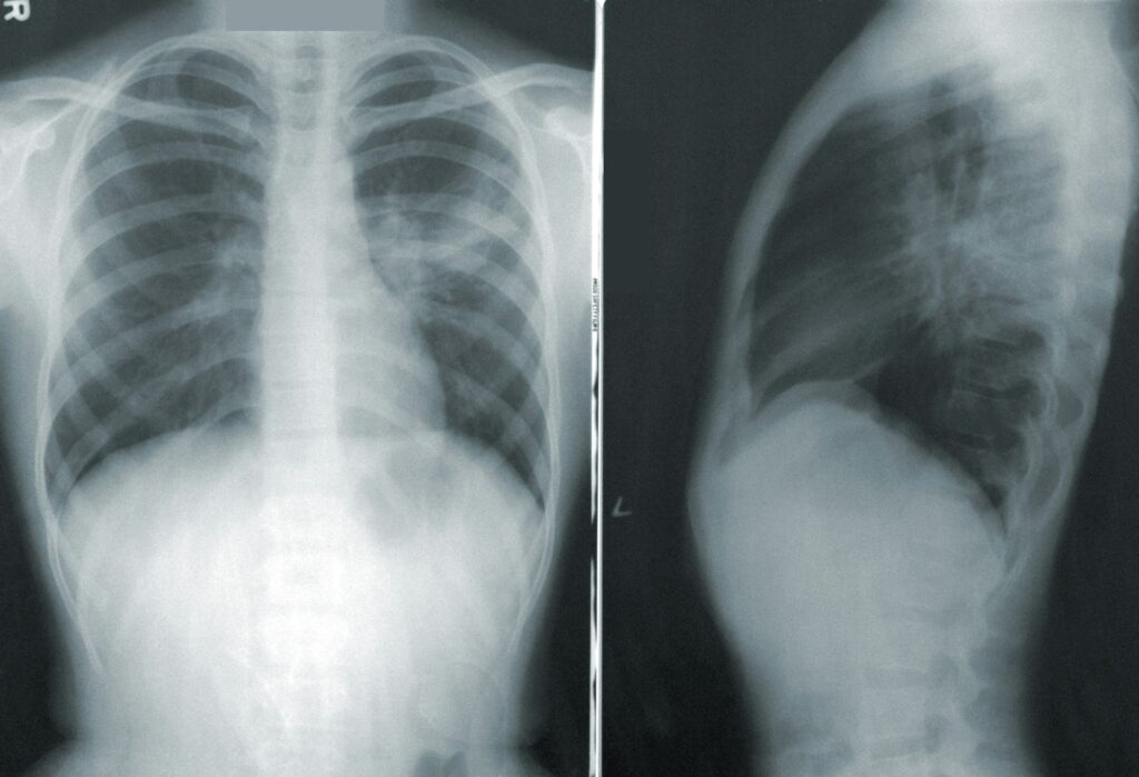 Gli studi globali di fase III dimostrano che nerandomilast ha rallentato il declino della funzionalità polmonare nella IPF e nella PPF, con valori simili di interruzione rispetto al placebo