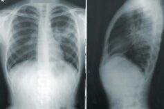 Nerandomilast rallenta il declino della funzionalità polmonare nella IPF e nella PPF, con valori simili di interruzione rispetto al placebo