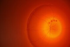 Degenerazione maculare precoce: l’eparan solfato è la chiave per prevenirla?