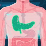 malattie pancreatiche