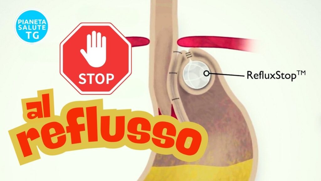 Reflusso gastroesofageo: la rivoluzione mini-invasiva che cambia la vita ai pazienti 1 Reflusso gastroesofageo: la rivoluzione mini-invasiva che cambia la vita ai pazienti