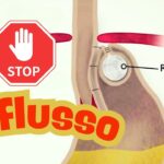 Reflusso gastroesofageo: la rivoluzione mini-invasiva che cambia la vita ai pazienti