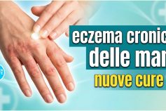 Eczema cronico delle mani: le nuove frontiere terapeutiche per una patologia invalidante
